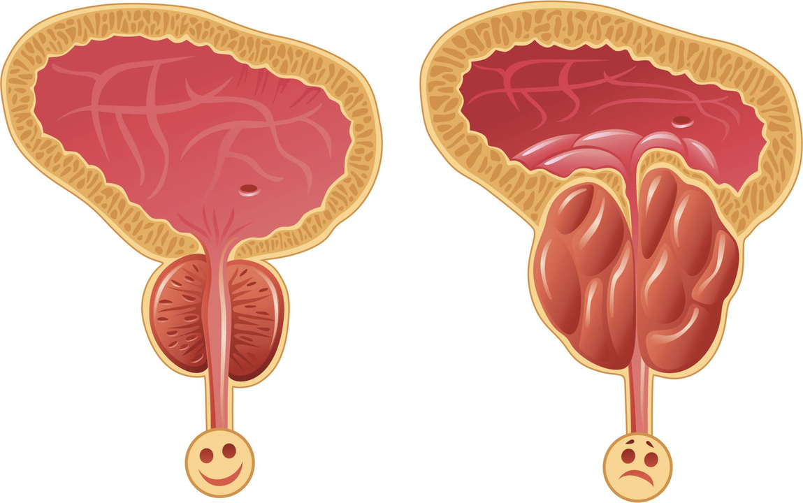 Como determinar a presenza de prostatite