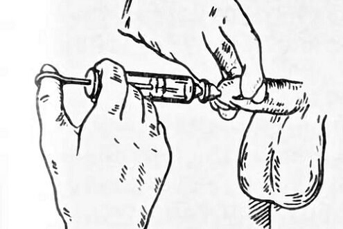 instilacións para prostatite