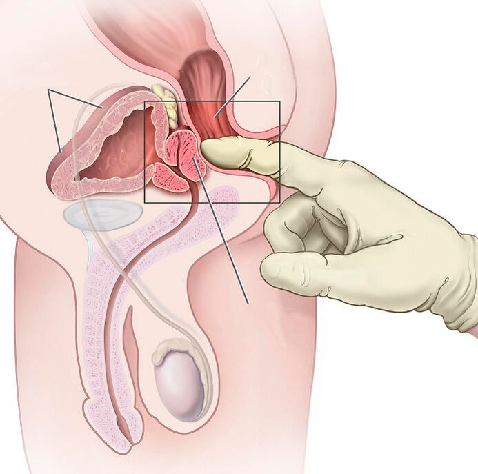 Masaxe de próstata para o tratamento da prostatite